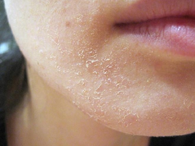 Quá lợi dụng cà chua trong việc dưỡng da sẽ dẫn dến da bị khô và tổn thương