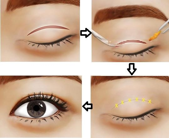 Việc thực hiện thẩm mỹ cắt mí mắt sẽ không xảy ra biến chứng nếu như đảm bảo đúng quy trình và yêu cầu kĩ thuật