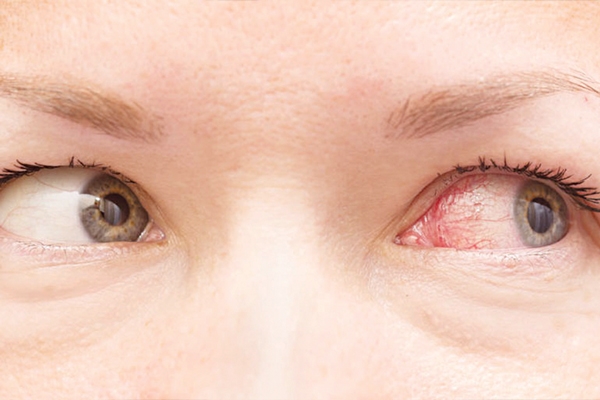 Nhiễm trùng mắt là do dùng quá nhiều mỹ phẩm đắp lên mắt