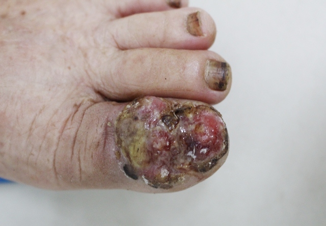 Hình ảnh bệnh nhân ung thư da bị viêm loét, hoại tử ngón chân.