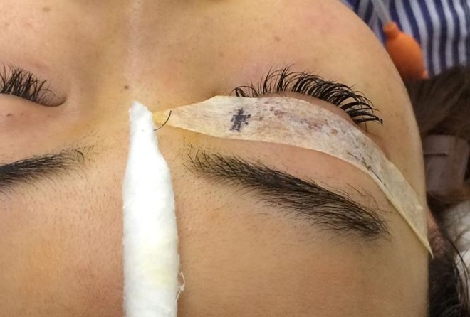 Cây kim phẫu thuật sau khi 'thất lạc' đã được lấy ra khỏi hốc mắt bệnh nhân.