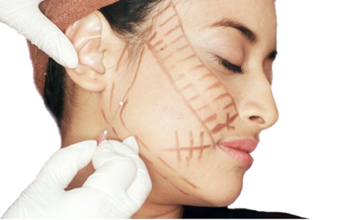 Phẫu thuật căng da mặt sẽ luôn để lại sẹo.