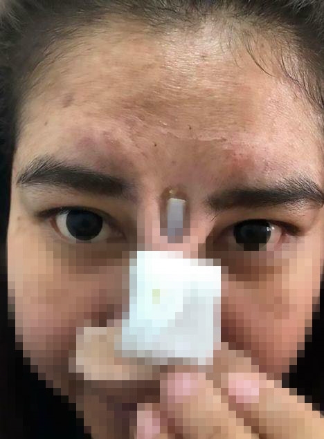 Một phụ nữ Thái Lan bị lồi sụn sau thẩm mỹ mũi