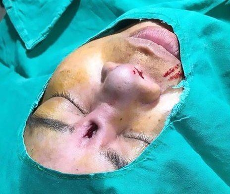 Cô gái Thái Lan được phẫu thuật tháo thanh silicone ra khỏi mũi 