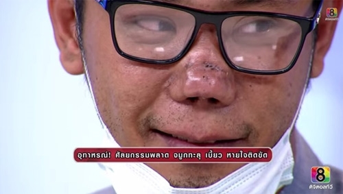 Chiếc mũi của Khun Nat bị thương tổn sau khi thẩm mỹ